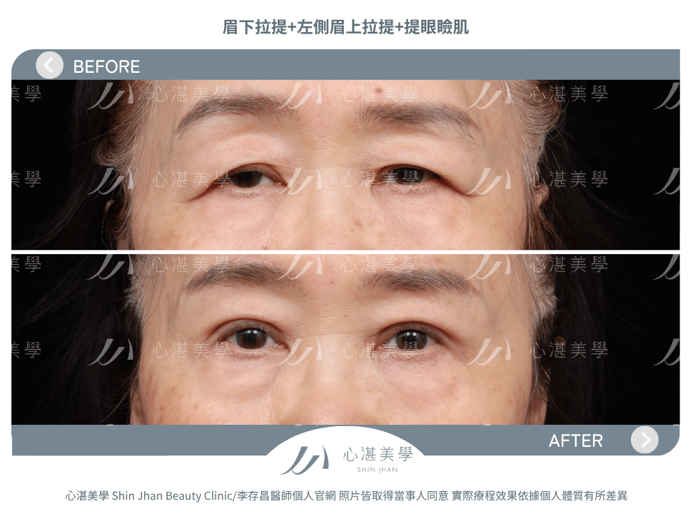 眉下拉提+提眼瞼肌 術前術後案例分享
