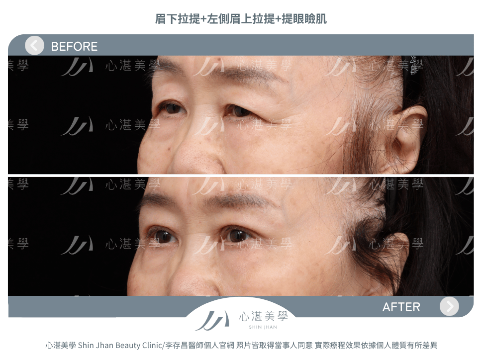 眉下拉提+提眼瞼肌 術前術後案例分享