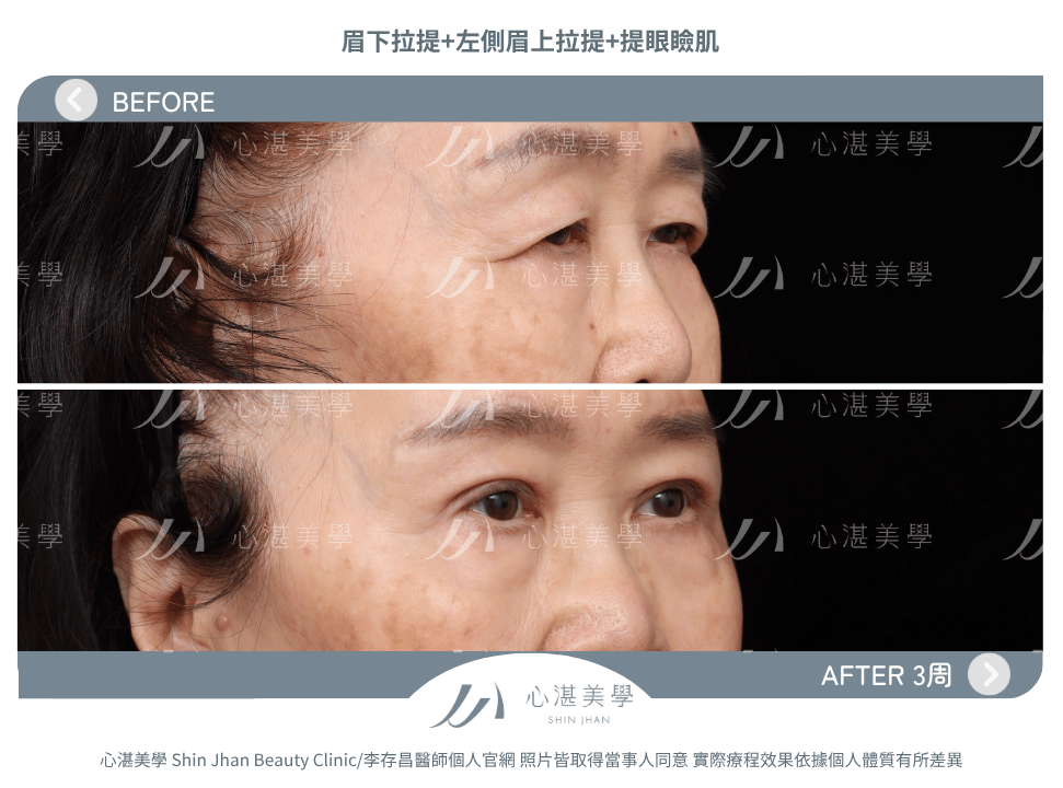 眉下拉提+提眼瞼肌 術前術後案例分享