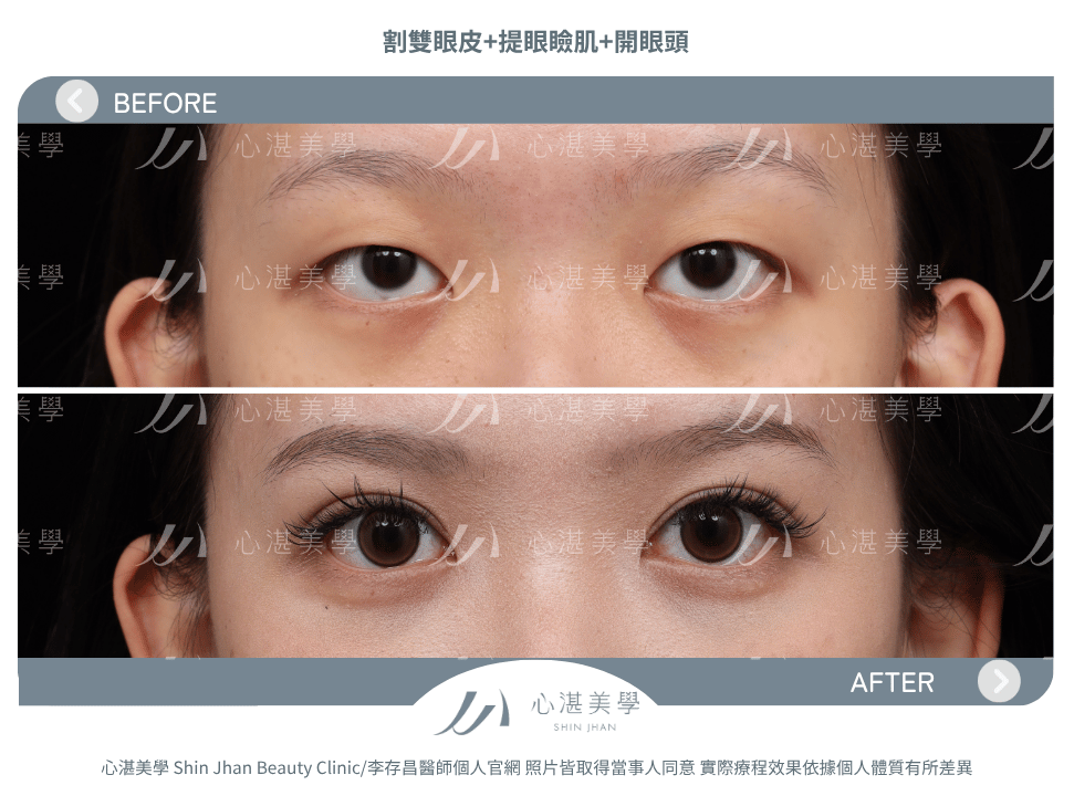 割雙眼皮+提眼瞼肌+開眼頭 術前術後案例分享