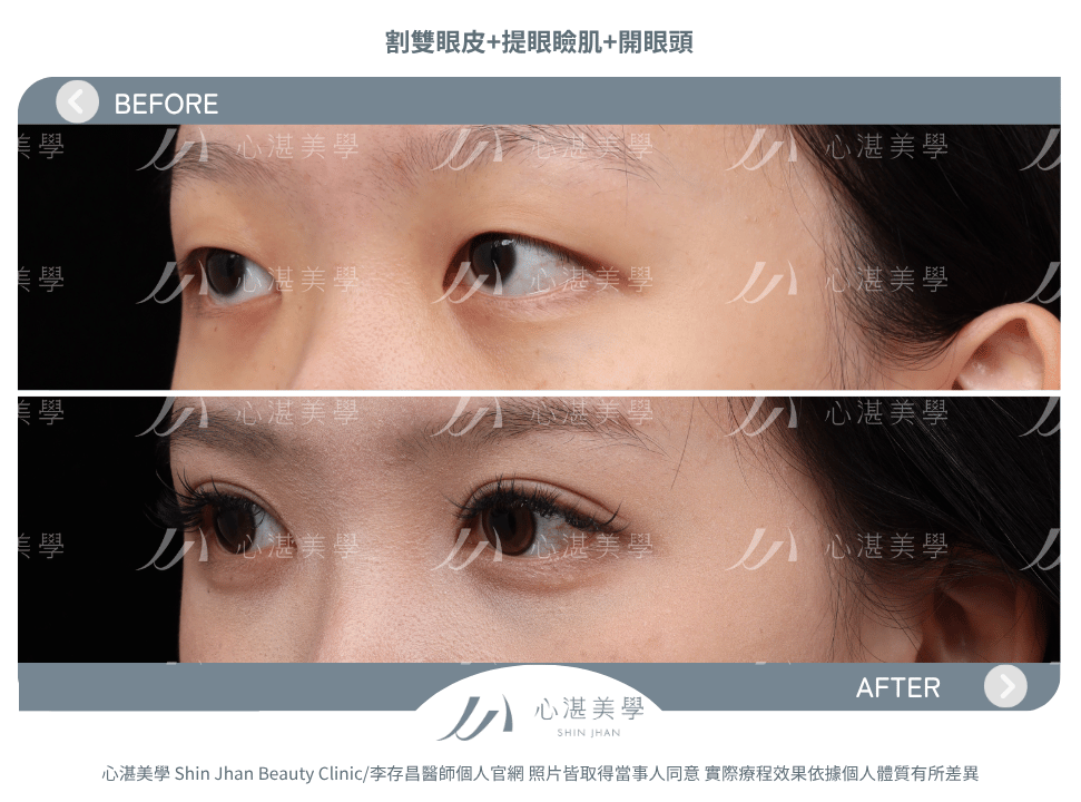 割雙眼皮+提眼瞼肌+開眼頭 術前術後案例分享