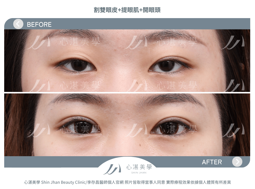 割雙眼皮+提眼瞼肌+開眼頭 術前術後案例分享
