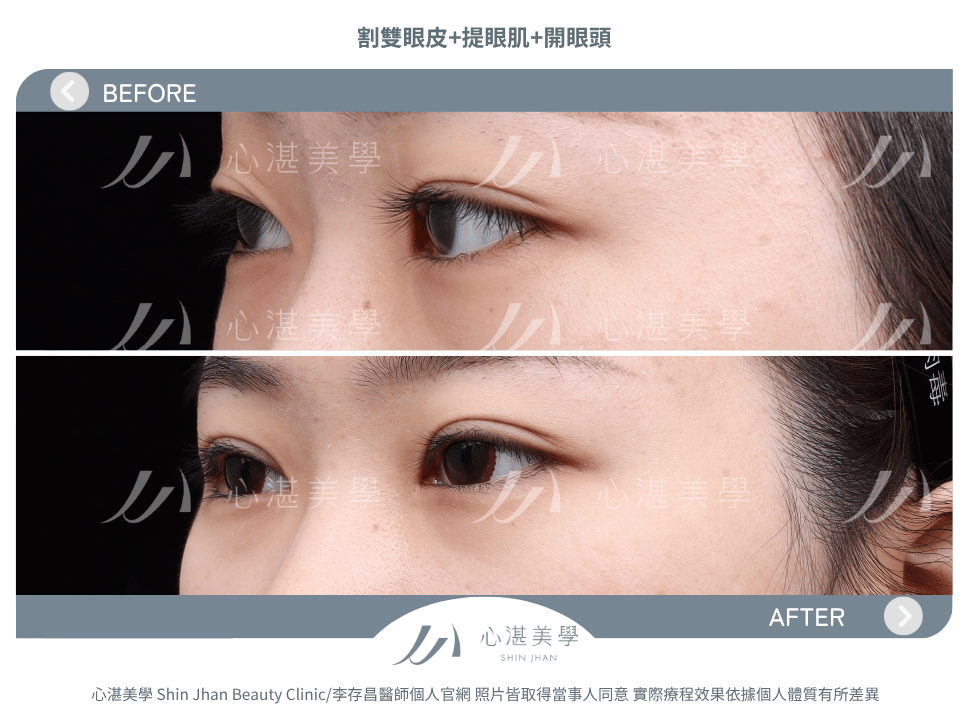割雙眼皮+提眼瞼肌+開眼頭 術前術後案例分享