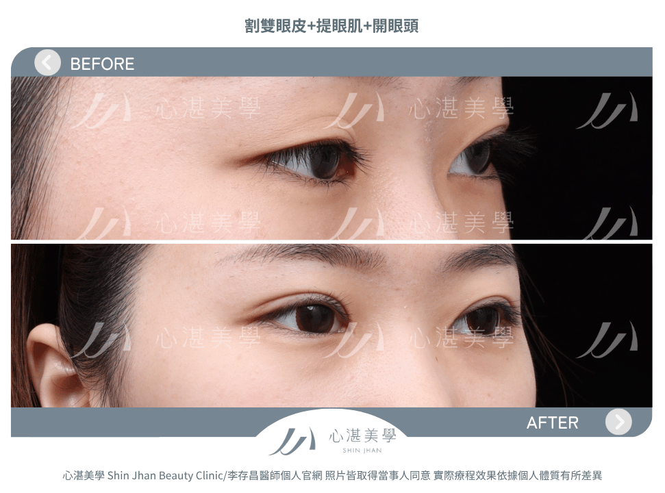 割雙眼皮+提眼瞼肌+開眼頭 術前術後案例分享