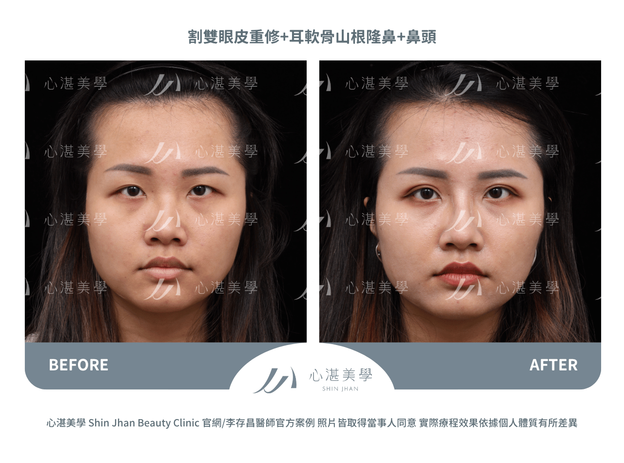 耳軟骨隆鼻+雙眼皮重修術前術後案例分享