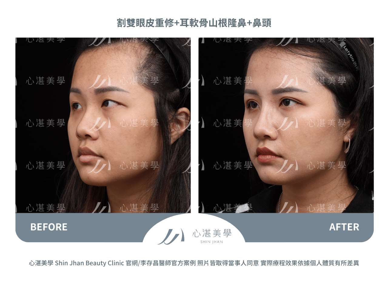 耳軟骨隆鼻+雙眼皮重修術前術後案例分享