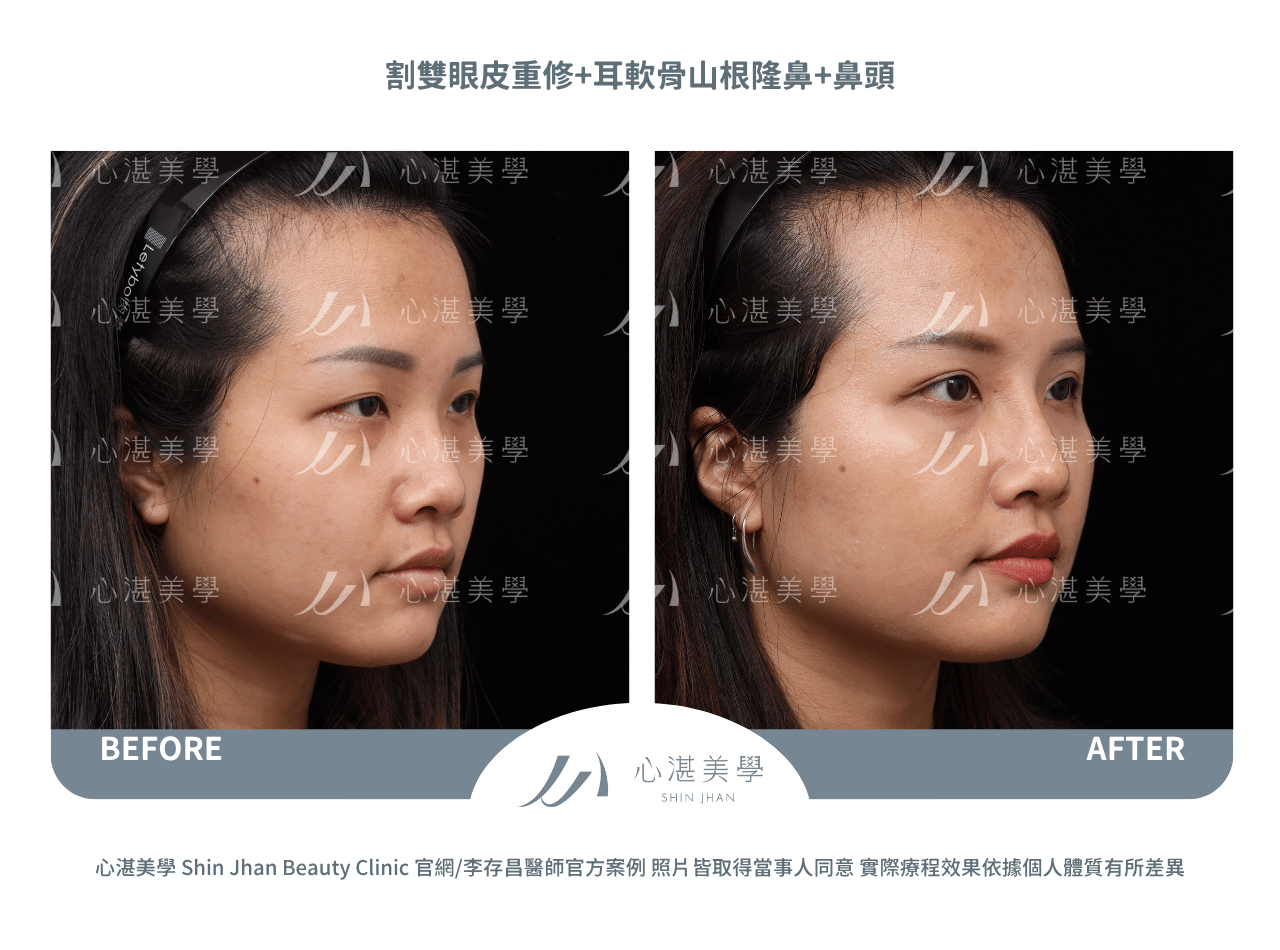 耳軟骨隆鼻+雙眼皮重修術前術後案例分享