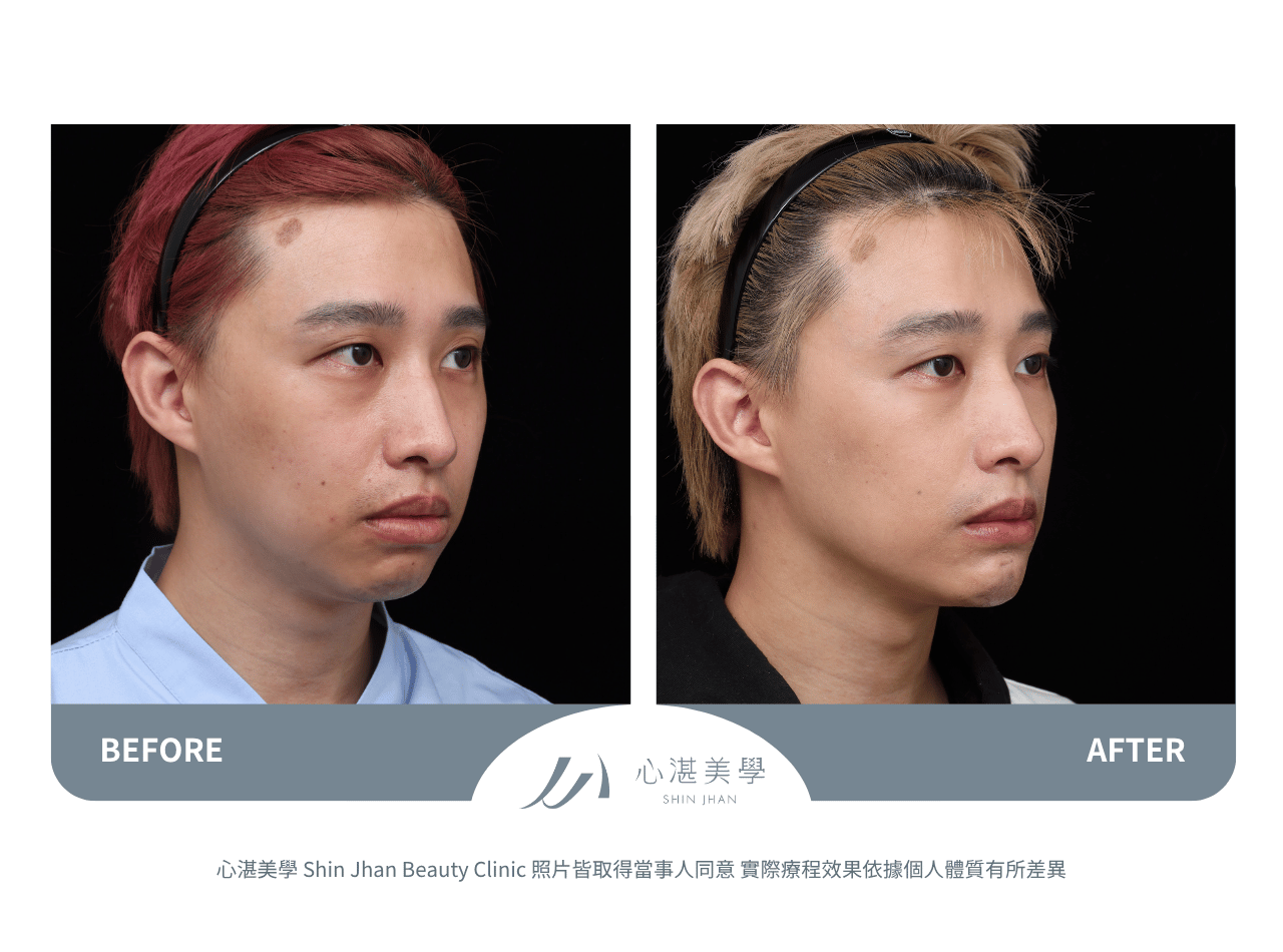 下巴截骨術前術後案例分享