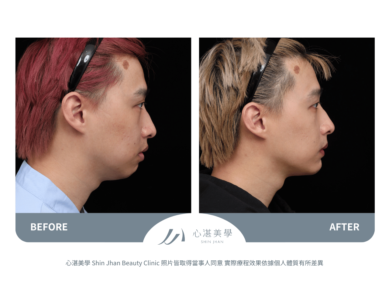 下巴截骨術前術後案例分享