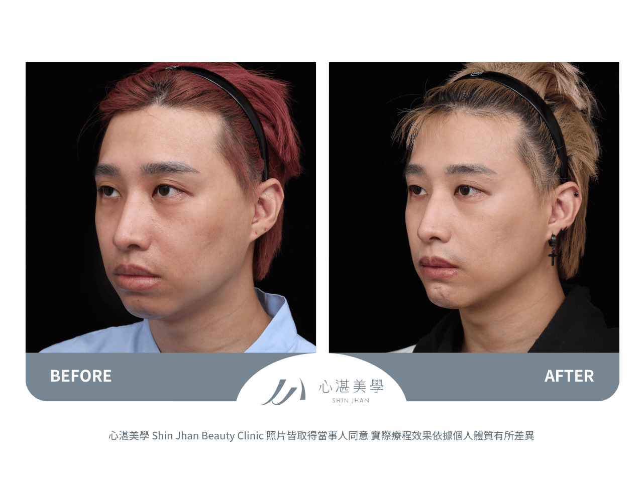 下巴截骨術前術後案例分享
