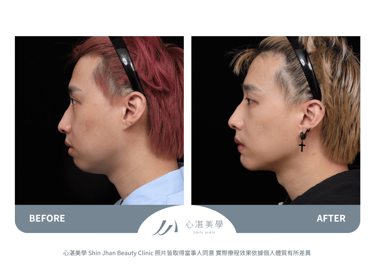 下巴截骨術前術後案例分享