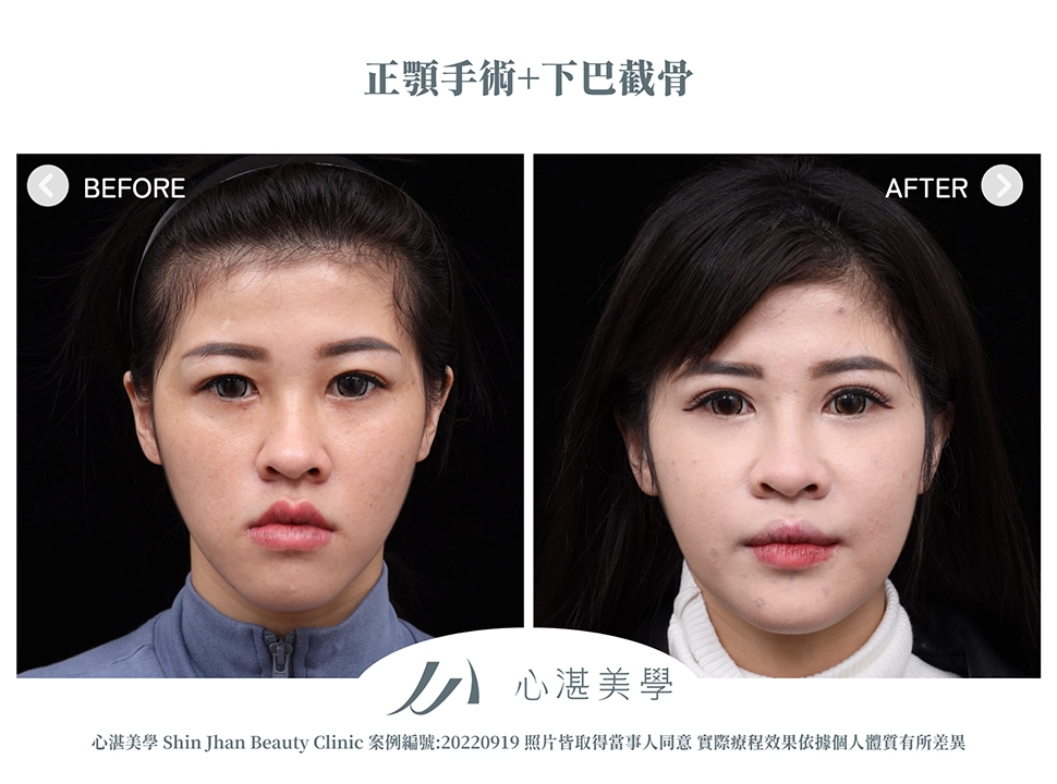 正顎手術+下巴截骨術前術後案例分享