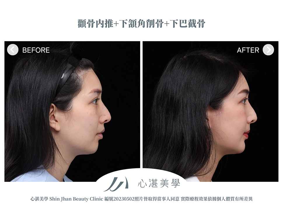 顴骨內推+下頷角削骨+下巴截骨術前術後案例分享