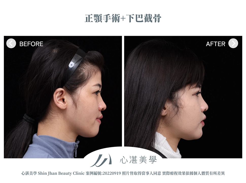 正顎手術+下巴截骨術前術後案例分享