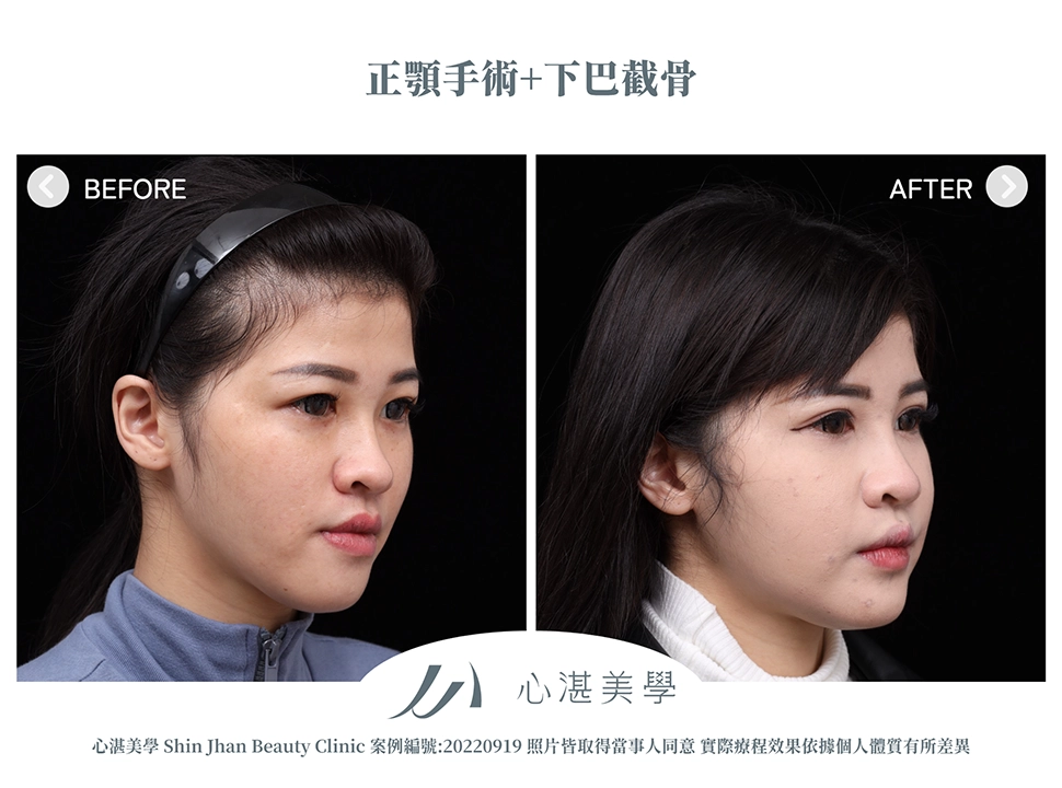 正顎手術+下巴截骨術前術後案例分享