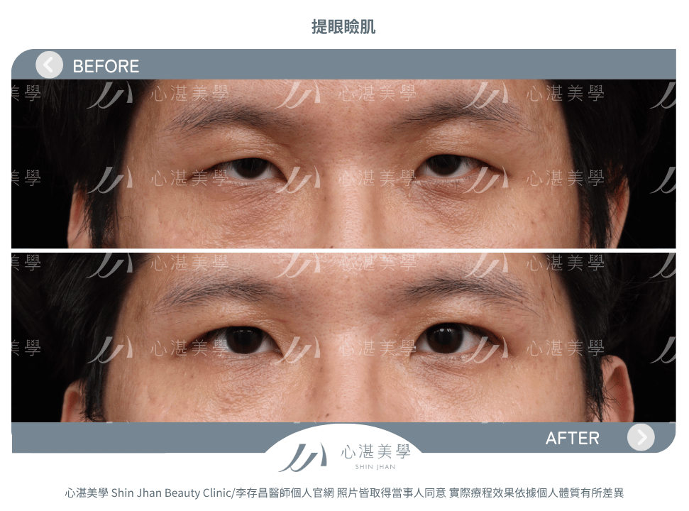 提眼瞼肌 術前術後案例分享