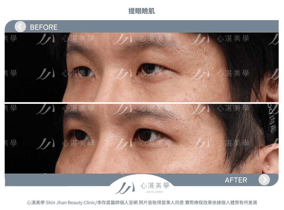 提眼瞼肌 術前術後案例分享