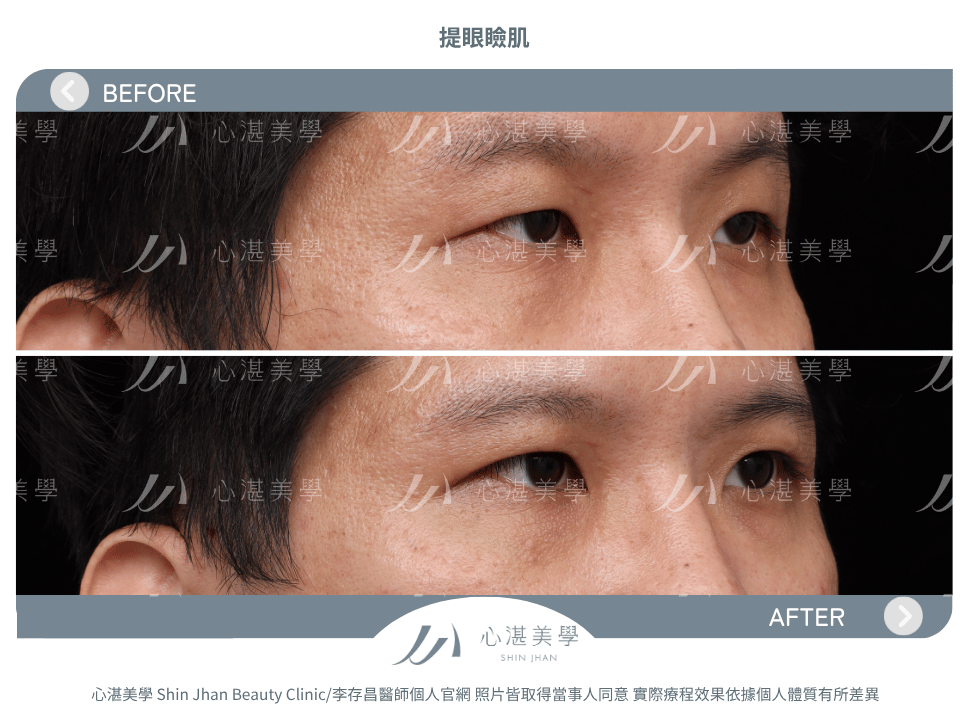 提眼瞼肌 術前術後案例分享
