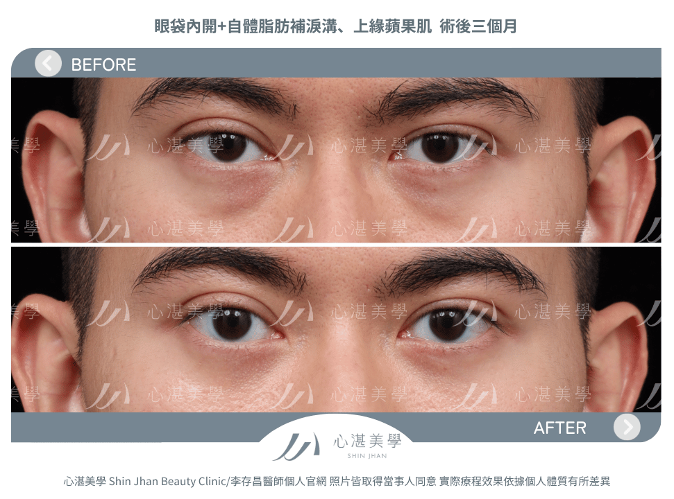 眼袋內開+自體脂肪補淚溝蘋果肌 術前術後案例分享