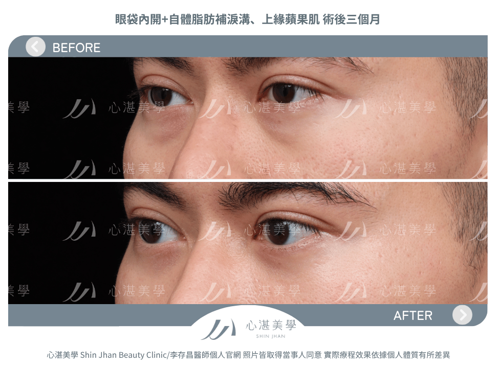 眼袋內開+自體脂肪補淚溝蘋果肌 術前術後案例分享