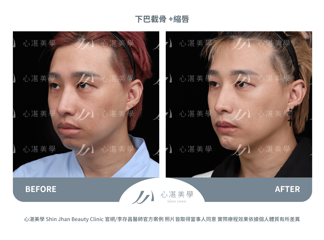 下巴截骨+縮下唇手術術前術後案例分享