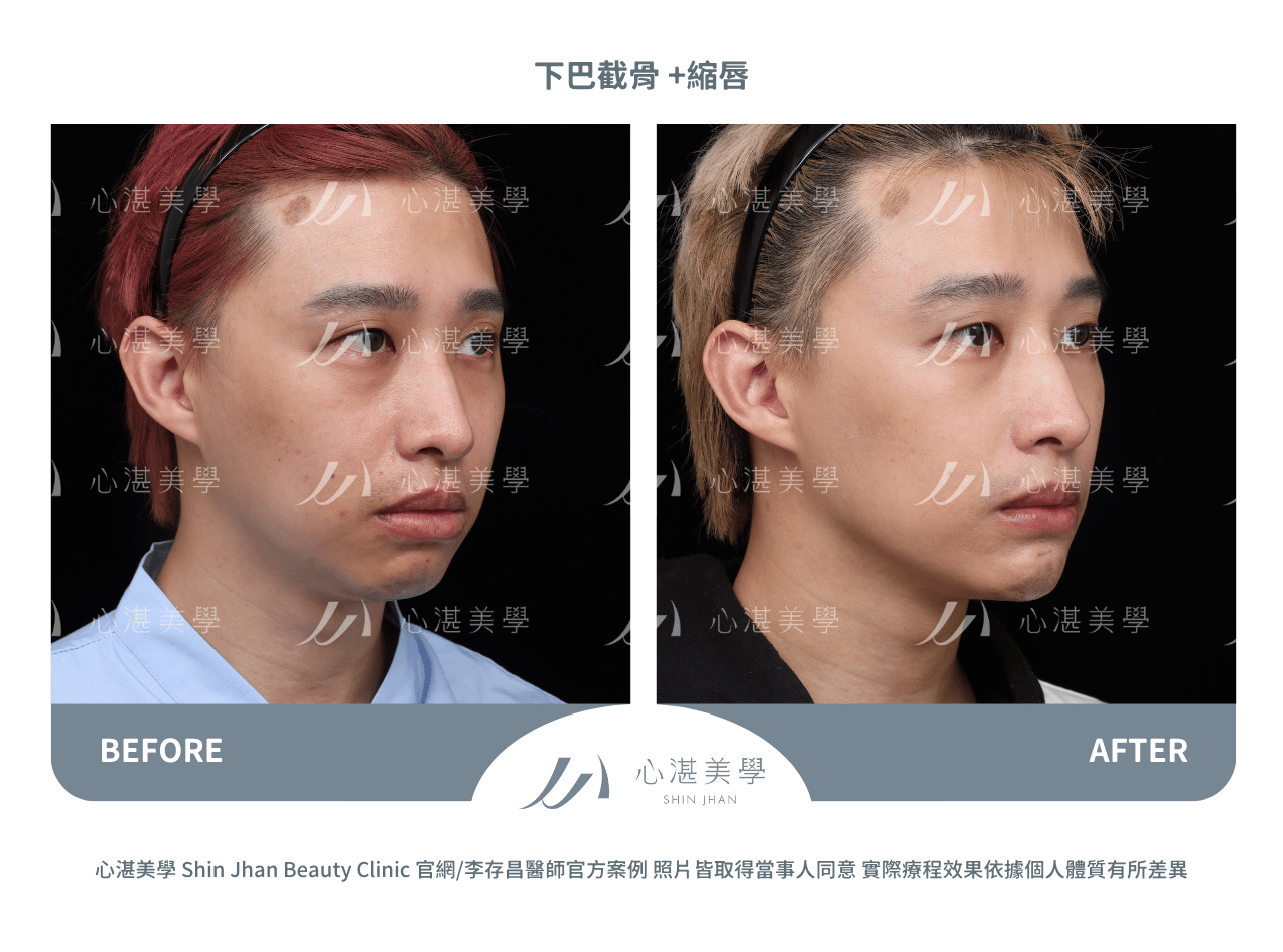 下巴截骨+縮下唇手術術前術後案例分享