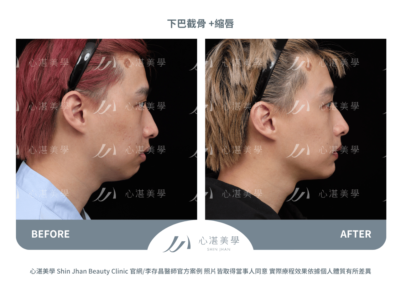 下巴截骨+縮下唇手術術前術後案例分享