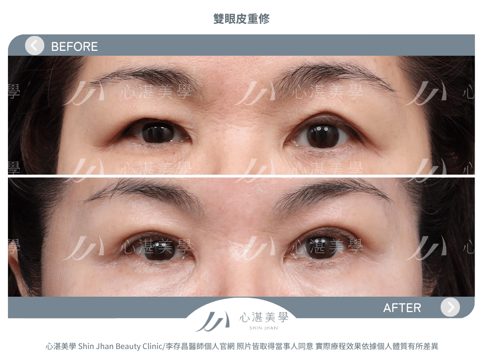 雙眼皮重修的常見原因:多層眼皮或疤痕問題 術前術後案例分享