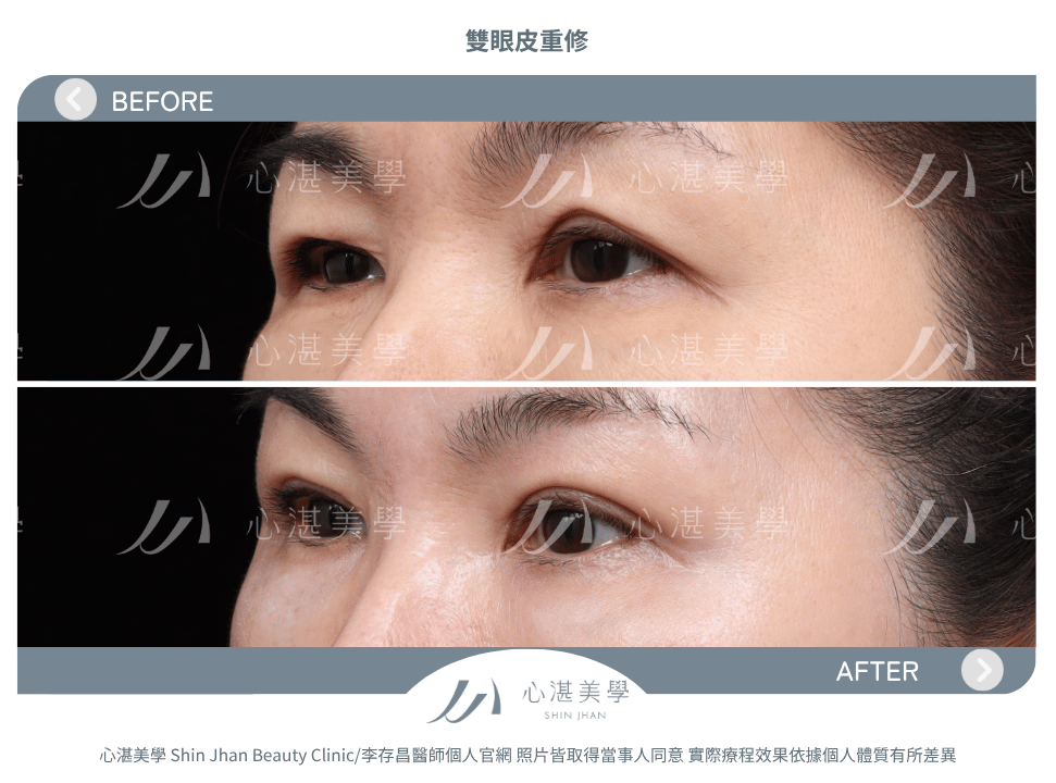 雙眼皮重修的常見原因:多層眼皮或疤痕問題 術前術後案例分享