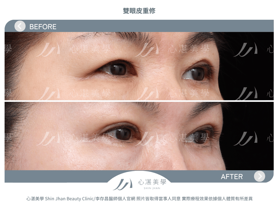 雙眼皮重修的常見原因:多層眼皮或疤痕問題 術前術後案例分享