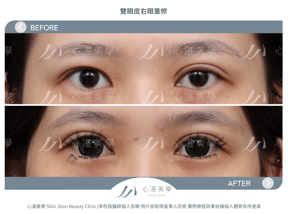 雙眼皮重修的常見原因:雙眼不對稱 術前術後案例分享
