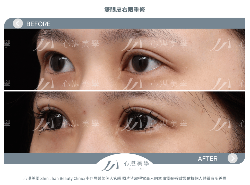 雙眼皮重修的常見原因:雙眼不對稱 術前術後案例分享