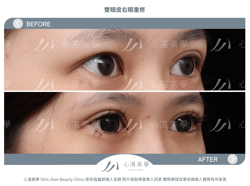 雙眼皮重修的常見原因:雙眼不對稱 術前術後案例分享