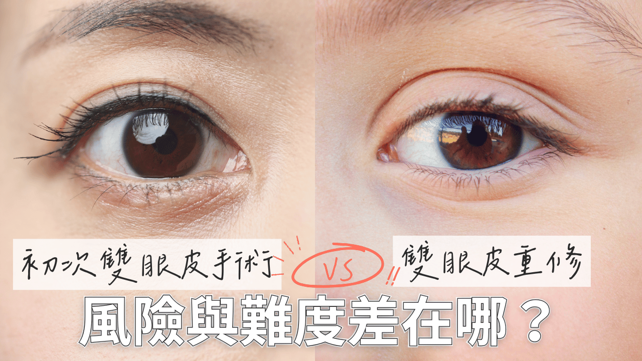 雙眼皮重修 VS 初次雙眼皮手術:風險與難度差在哪?