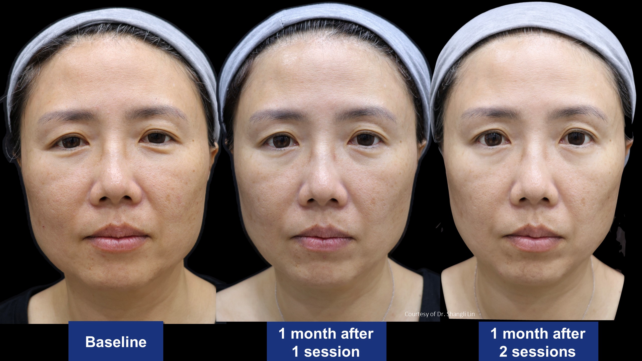 逆時針PROFHILO原廠術前術後案例分享