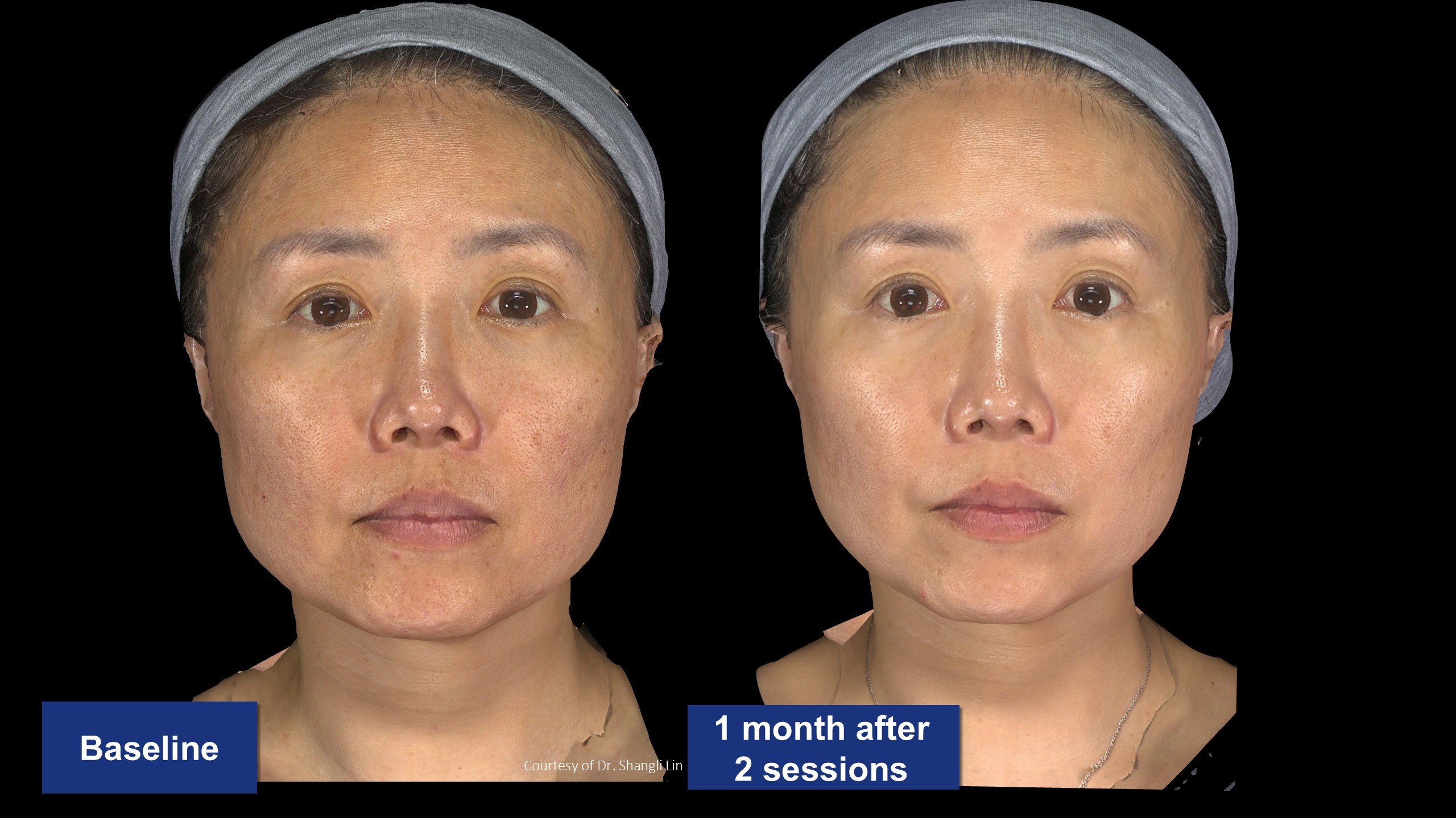 逆時針PROFHILO原廠術前術後案例分享