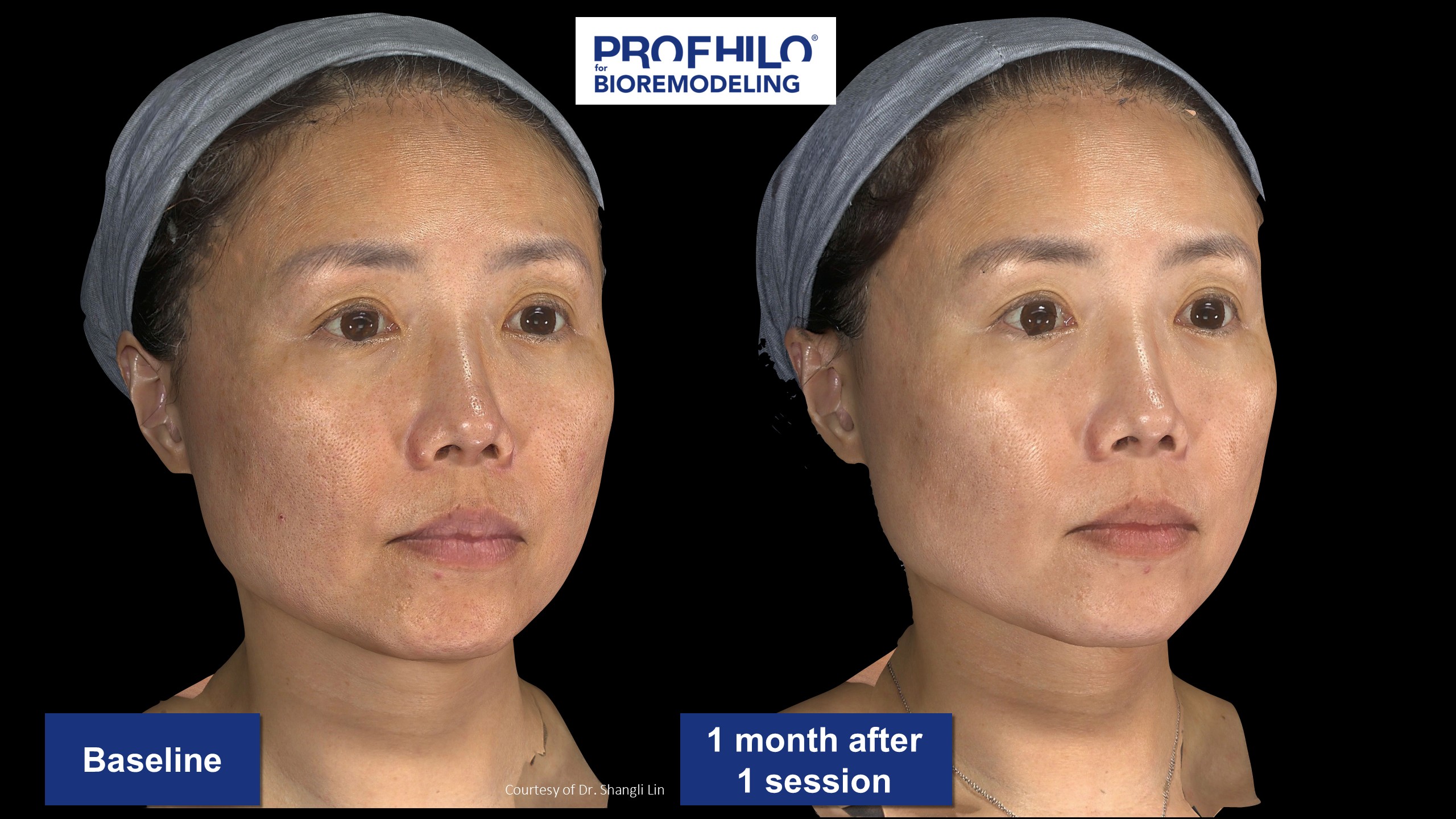 逆時針PROFHILO原廠術前術後案例分享