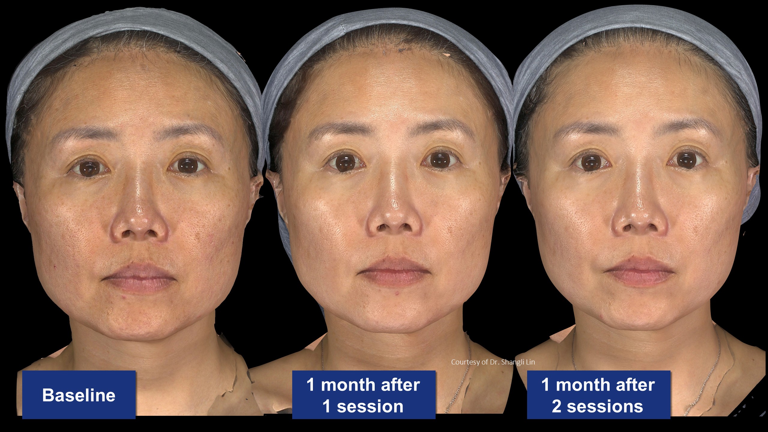 逆時針PROFHILO原廠術前術後案例分享