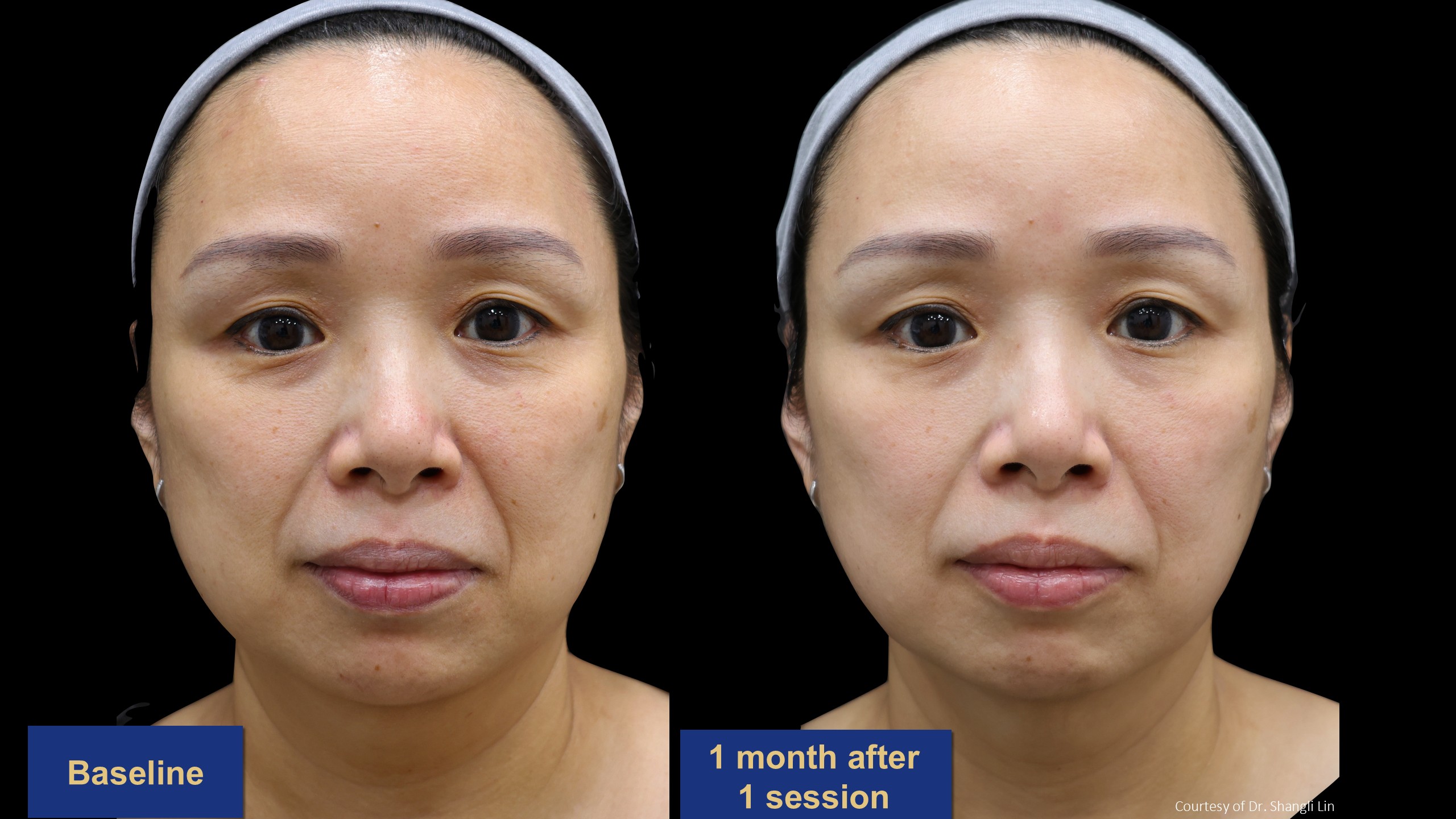 逆時針PROFHILO原廠術前術後案例分享