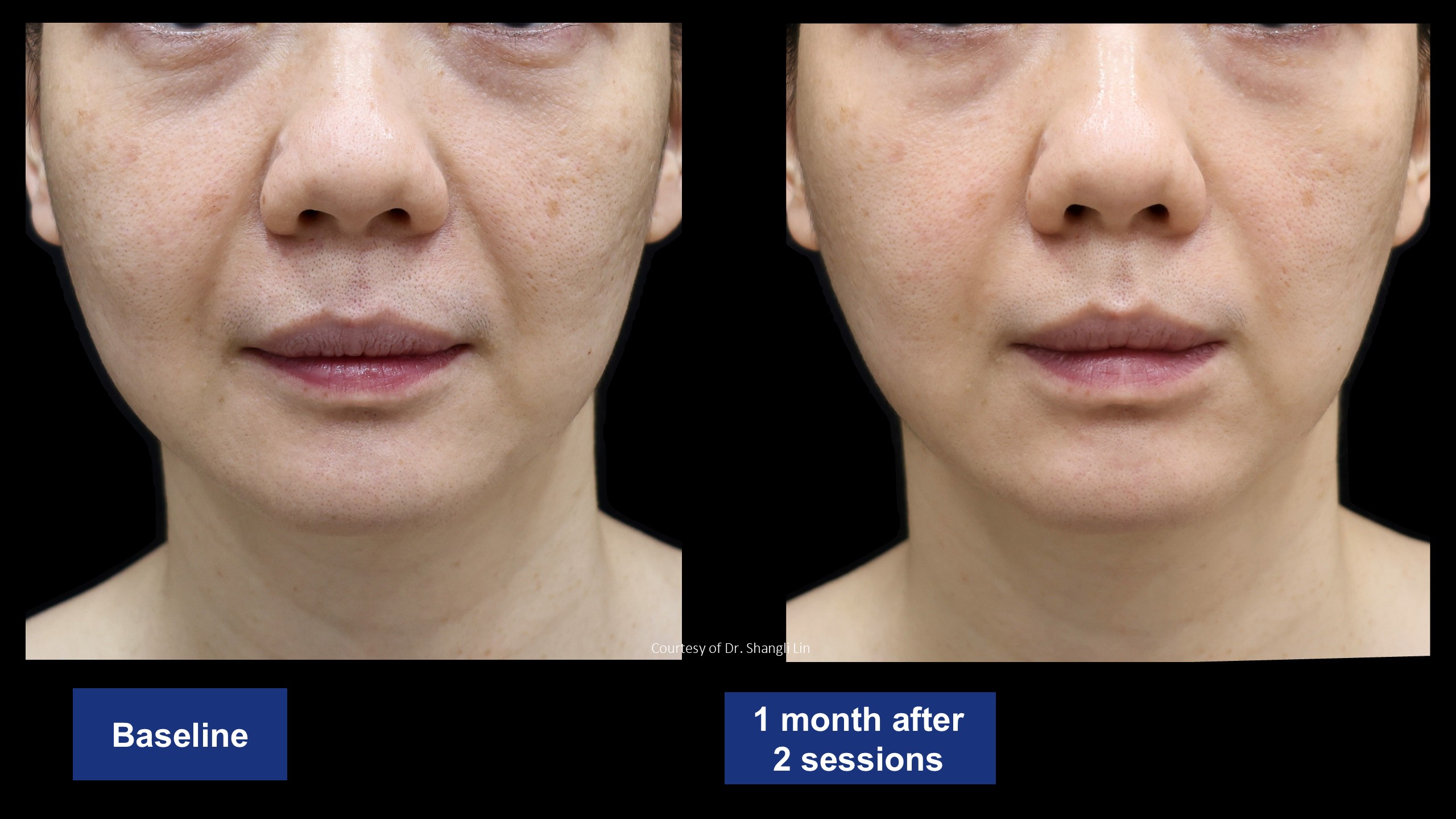 逆時針PROFHILO原廠術前術後案例分享