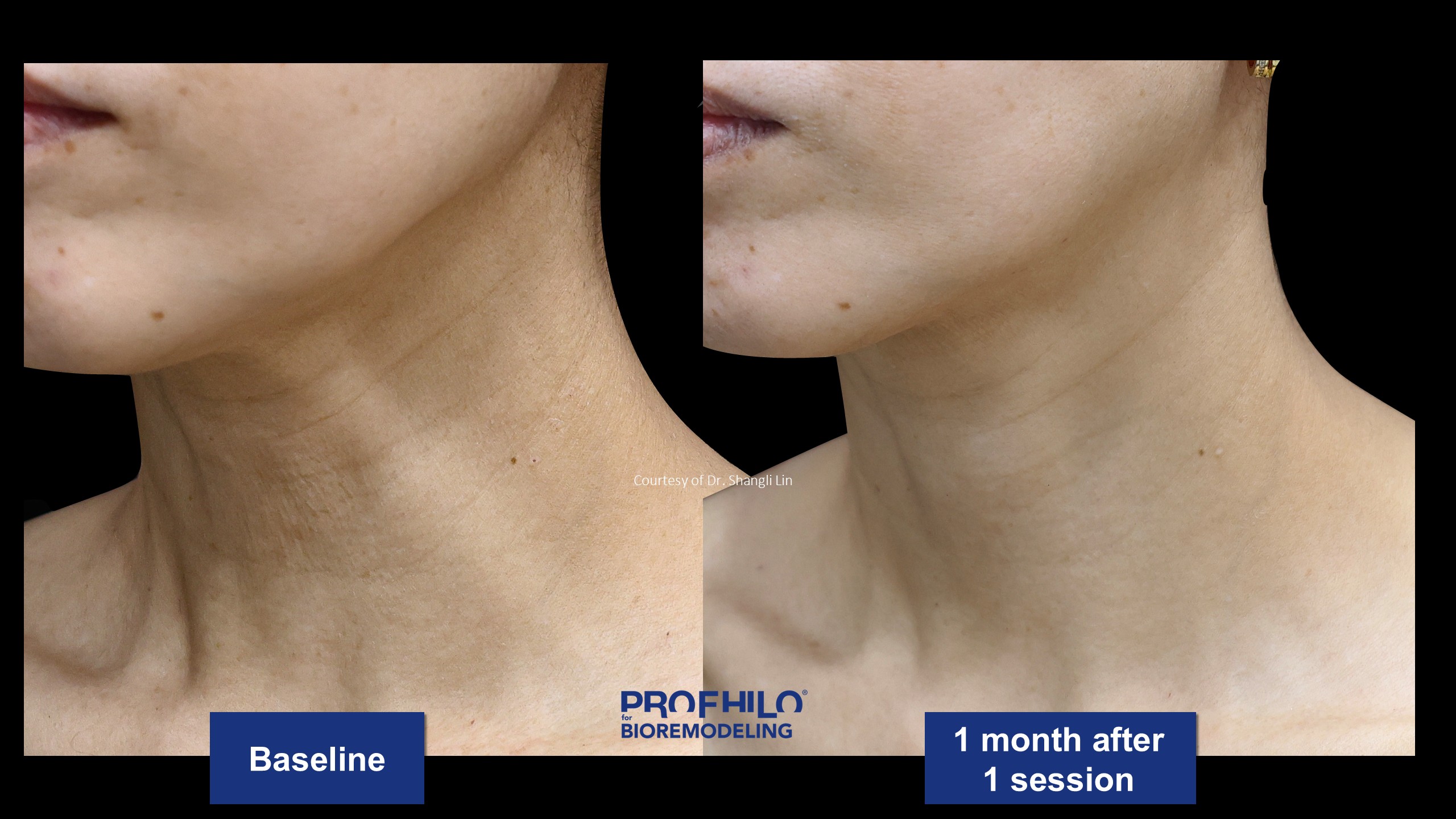 逆時針PROFHILO原廠術前術後案例分享