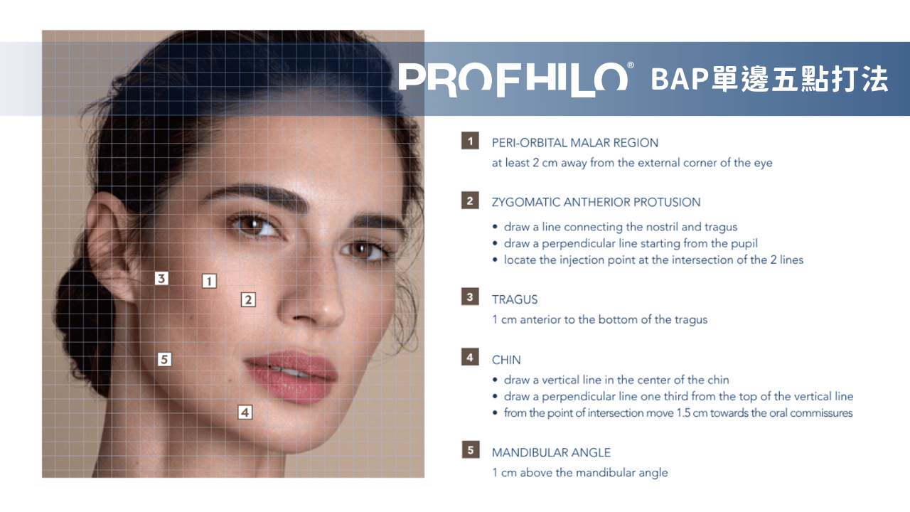逆時針PROFHILO的BAP 5點注射技術圖示，顯示臉部五個注射點位以啟動膠原蛋白增生