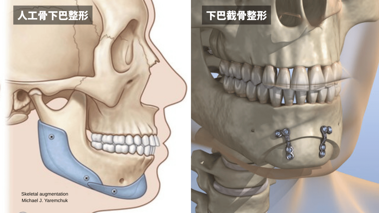 男性下巴整形手術示意圖，左邊為人工骨墊下巴，右邊為下巴截骨前移手術。
