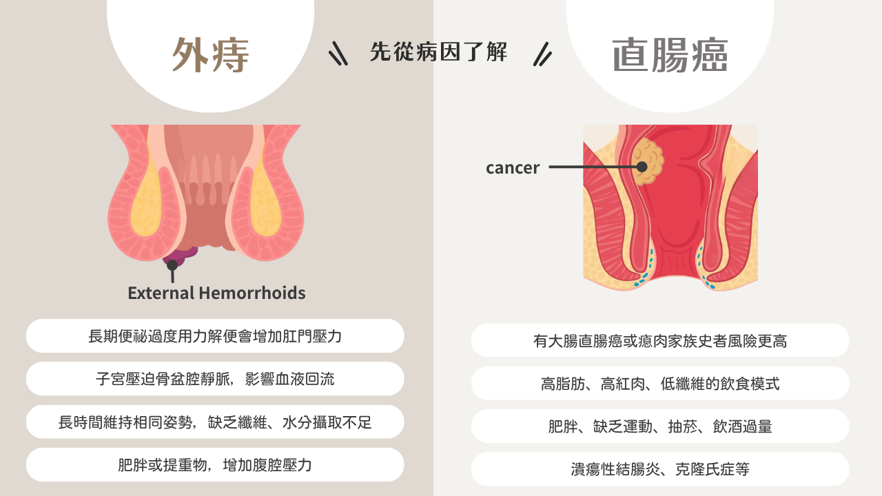 外痔是什麼？直腸癌又是什麼？