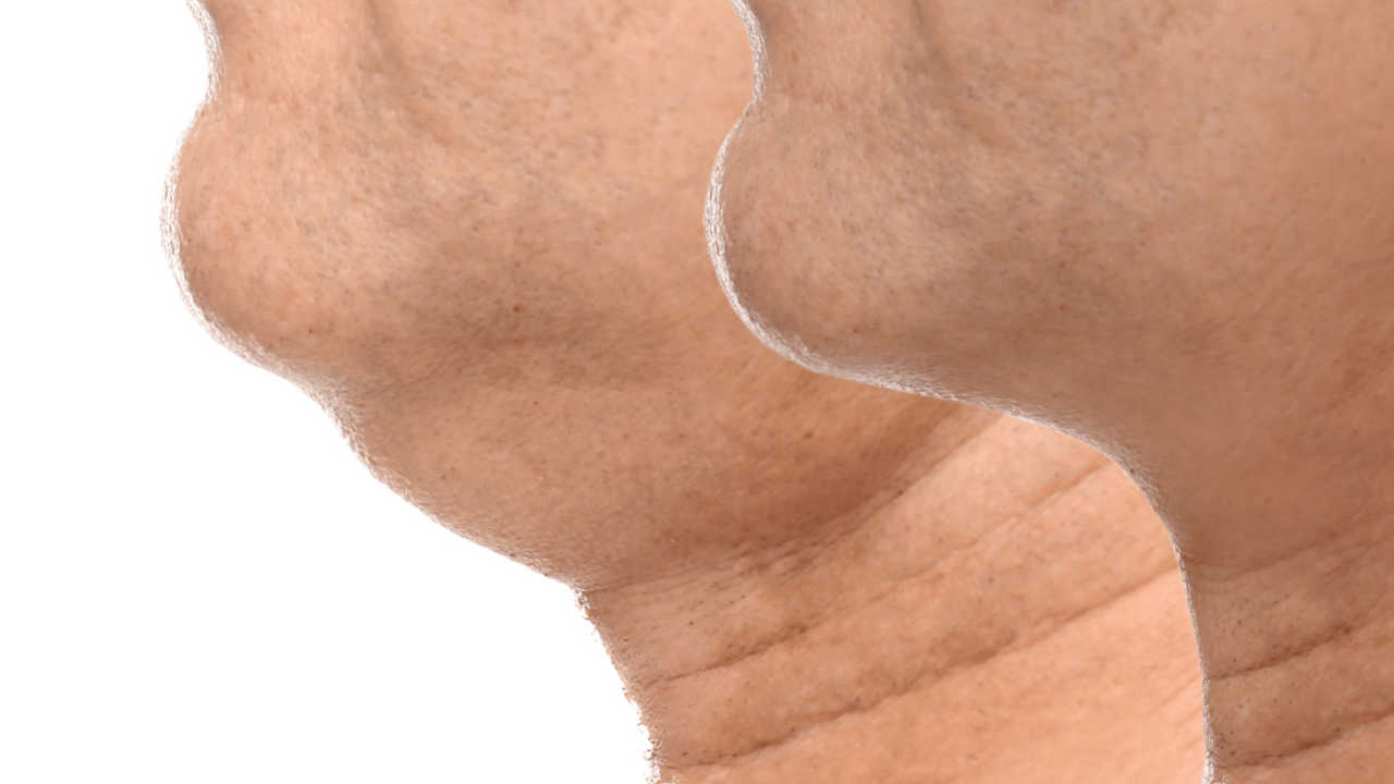 一位進行男性下巴整形的男性，展現其雕塑後充滿自信的完美下巴線條。