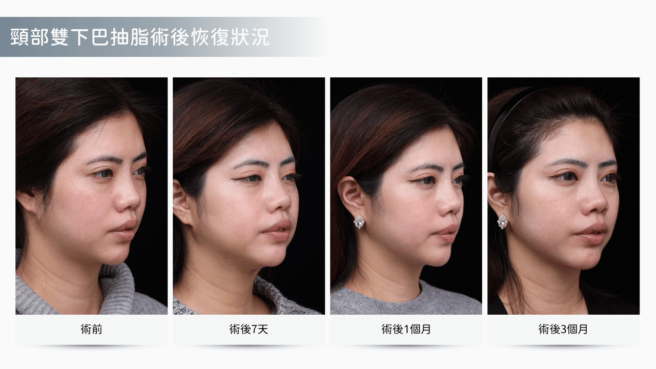 頸部抽脂真實案例分享： 3 個月後下顎線條更清晰俐落