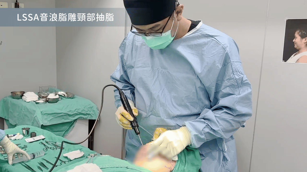 頸部抽脂手術範圍標示：精準移除雙下巴脂肪