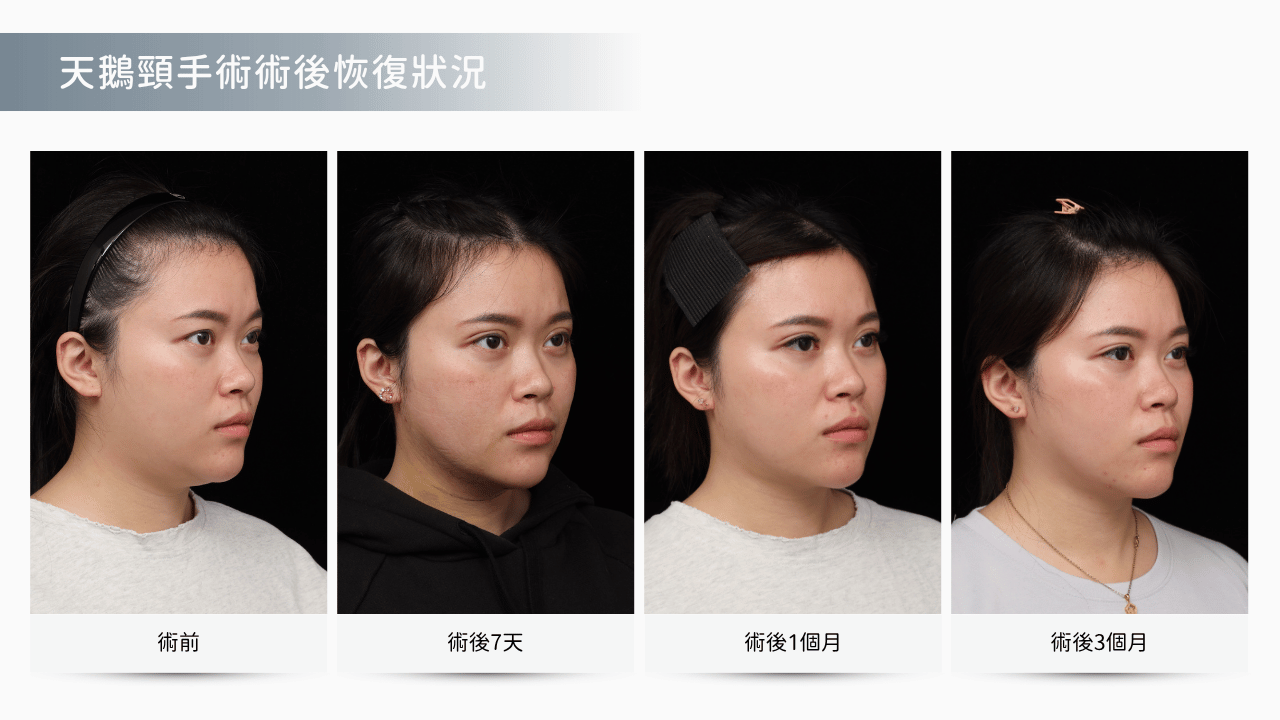天鵝頸手術真實案例分享： 3 個月後下顎線條更貼合緊實