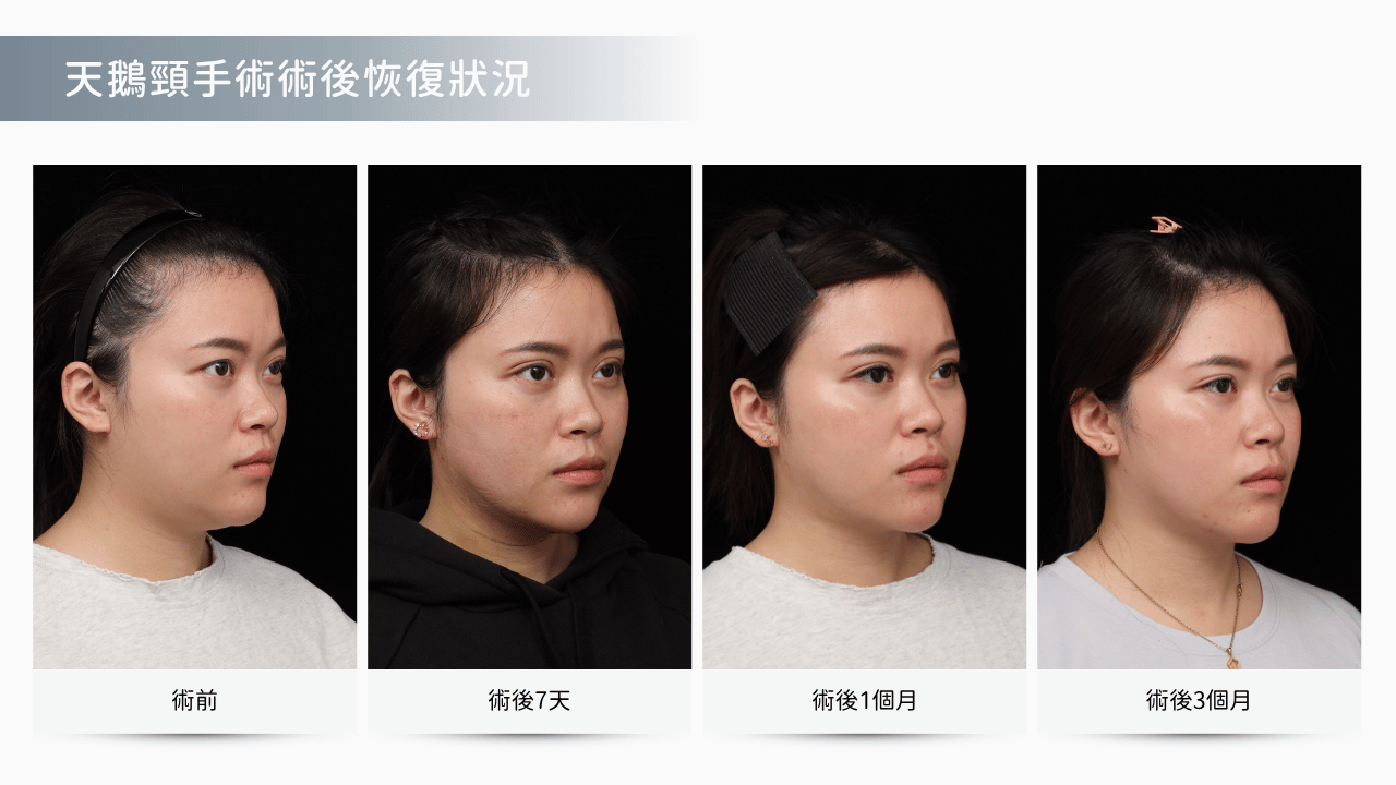天鵝頸手術_術後恢復期_臉部腫脹消退