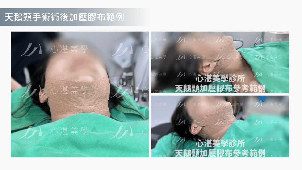 天鵝頸手術_術後恢復期_臉部腫脹消退